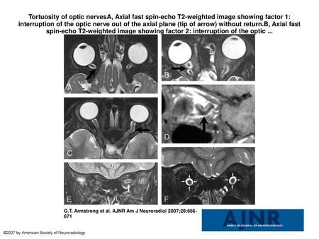 Tortuosity of optic nervesA, Axial fast spin-echo T2-weighted image showing factor 1: interruption of the optic nerve out of the axial plane (tip of arrow)