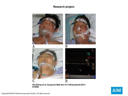 Research project. Research project. (A) Only intravenous injection of midazolam was given in group A. (B) Midazolam was given and acupuncture needles were.