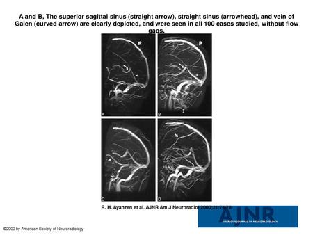 A and B, The superior sagittal sinus (straight arrow), straight sinus (arrowhead), and vein of Galen (curved arrow) are clearly depicted, and were seen.