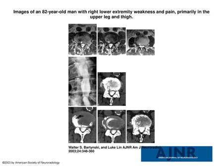 Images of an 82-year-old man with right lower extremity weakness and pain, primarily in the upper leg and thigh. Images of an 82-year-old man with right.