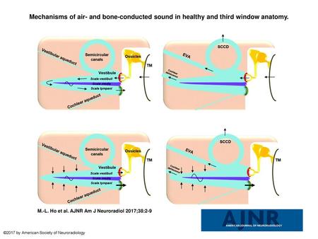 Mechanisms of air- and bone-conducted sound in healthy and third window anatomy. Mechanisms of air- and bone-conducted sound in healthy and third window.