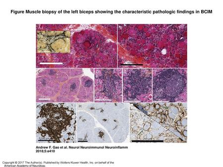 Figure Muscle biopsy of the left biceps showing the characteristic pathologic findings in BCIM Muscle biopsy of the left biceps showing the characteristic.