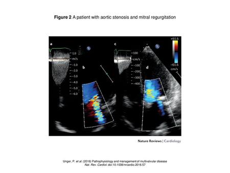 Figure 2 A patient with aortic stenosis and mitral regurgitation