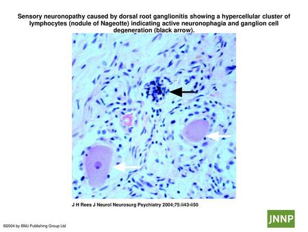 Sensory neuronopathy caused by dorsal root ganglionitis showing a hypercellular cluster of lymphocytes (nodule of Nageotte) indicating active neuronophagia.