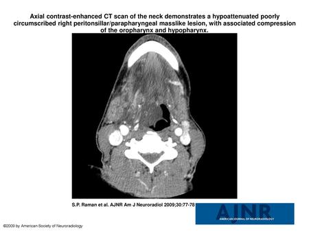 Axial contrast-enhanced CT scan of the neck demonstrates a hypoattenuated poorly circumscribed right peritonsillar/parapharyngeal masslike lesion, with.