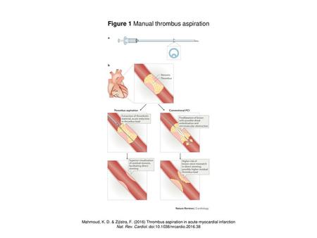 Figure 1 Manual thrombus aspiration