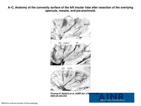 A–C, Anatomy of the convexity surface of the left insular lobe after resection of the overlying opercula, vessels, and pia-arachnoid. A–C, Anatomy of the.