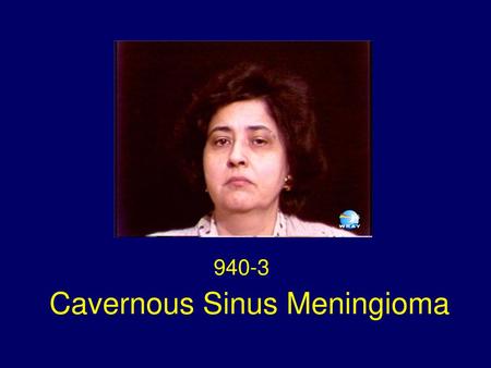 Cavernous Sinus Meningioma