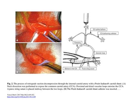 Fig. 2. The process of retrograde suction decompression through the internal carotid artery with a Pruitt-Inahara® carotid shunt. (A) Neck dissection was.