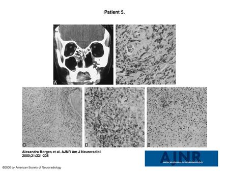 Patient 5. Patient 5. Initial diagnosis: nonhealing midline granuloma (Stewart's syndrome); final diagnosis: non-Hodgkin's T-cell lymphoma. A, CT scan.