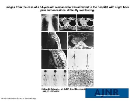 Images from the case of a 34-year-old woman who was admitted to the hospital with slight back pain and occasional difficulty swallowing. Images from the.