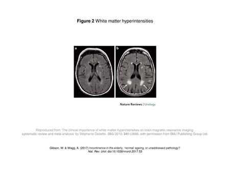 Figure 2 White matter hyperintensities