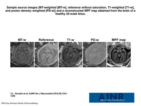 Sample source images (MT-weighted [MT-w], reference without saturation, T1-weighted [T1-w], and proton density–weighted [PD-w]) and a reconstructed MPF.