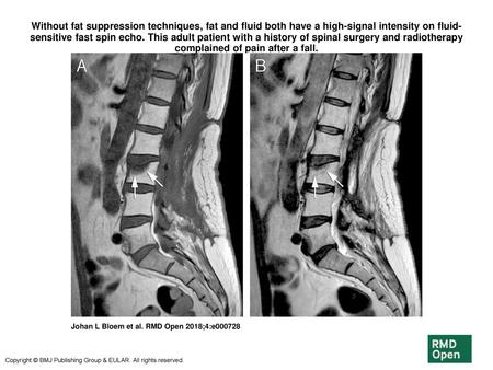 Without fat suppression techniques, fat and fluid both have a high-signal intensity on fluid-sensitive fast spin echo. This adult patient with a history.