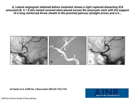 A, Lateral angiogram obtained before treatment shows a right ruptured dissecting ICA aneurysm.B, 4 × 9 mm Jomed covered stent placed across the aneurysm.