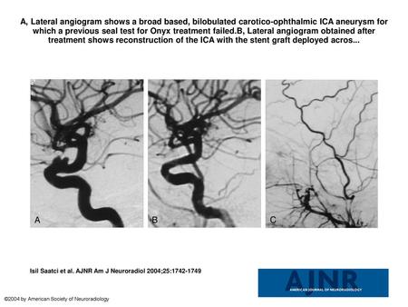 A, Lateral angiogram shows a broad based, bilobulated carotico-ophthalmic ICA aneurysm for which a previous seal test for Onyx treatment failed.B, Lateral.