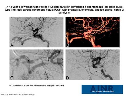 A 43-year-old woman with Factor V Leiden mutation developed a spontaneous left-sided dural type (indirect) carotid cavernous fistula (CCF) with proptosis,