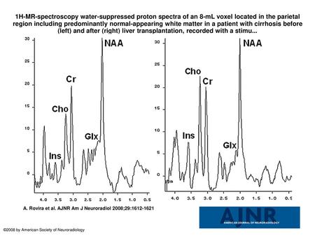 1H-MR-spectroscopy water-suppressed proton spectra of an 8-mL voxel located in the parietal region including predominantly normal-appearing white matter.