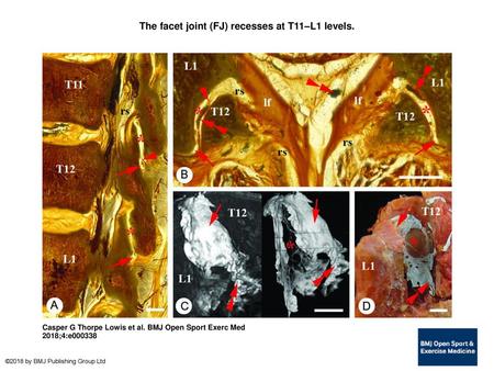 The facet joint (FJ) recesses at T11–L1 levels.