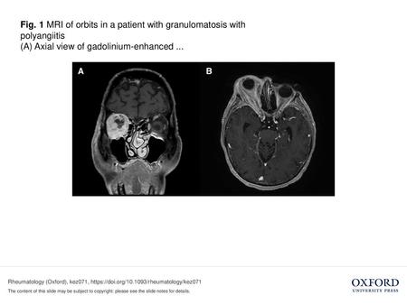 (A) Axial view of gadolinium-enhanced ...