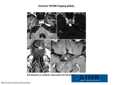 Common VW-MR imaging pitfalls.