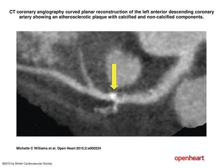 CT coronary angiography curved planar reconstruction of the left anterior descending coronary artery showing an atherosclerotic plaque with calcified and.