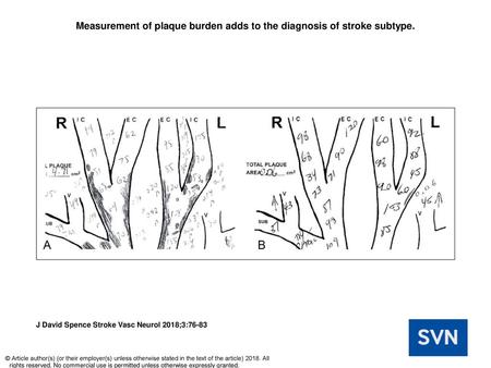 Measurement of plaque burden adds to the diagnosis of stroke subtype.