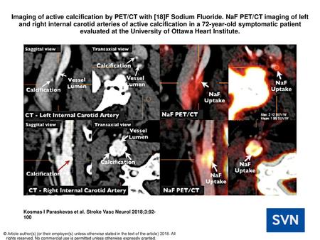 Imaging of active calcification by PET/CT with [18]F Sodium Fluoride