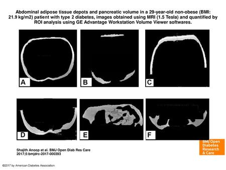 Abdominal adipose tissue depots and pancreatic volume in a 29-year-old non-obese (BMI: 21.9 kg/m2) patient with type 2 diabetes, images obtained using.