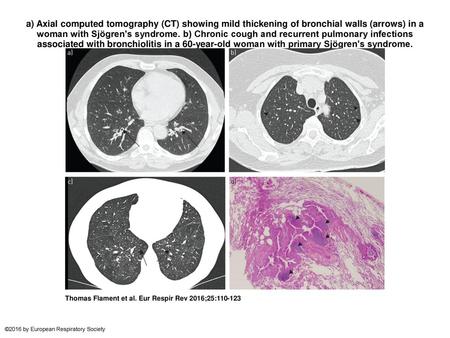 A) Axial computed tomography (CT) showing mild thickening of bronchial walls (arrows) in a woman with Sjögren's syndrome. b) Chronic cough and recurrent.