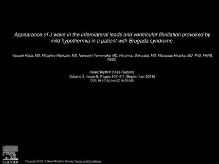 Appearance of J wave in the inferolateral leads and ventricular fibrillation provoked by mild hypothermia in a patient with Brugada syndrome  Yasuaki.