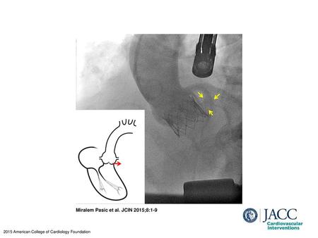 Miralem Pasic et al. JCIN 2015;8:1-9