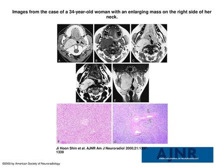 Images from the case of a 34-year-old woman with an enlarging mass on the right side of her neck. Images from the case of a 34-year-old woman with an enlarging.