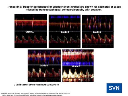 Transcranial Doppler screenshots of Spencer shunt grades are shown for examples of cases missed by transoesophageal echocardiography with sedation. Transcranial.