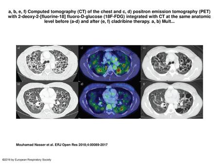 A, b, e, f) Computed tomography (CT) of the chest and c, d) positron emission tomography (PET) with 2-deoxy-2-[fluorine-18] fluoro-D-glucose (18F-FDG)