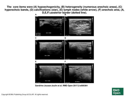 The  core items were (A) hypoechogenicity, (B) heterogeneity (numerous anechoic areas), (C) hyperechoic bands, (D) calcifications (star), (E) lymph nodes.