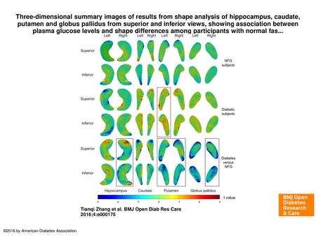 Three-dimensional summary images of results from shape analysis of hippocampus, caudate, putamen and globus pallidus from superior and inferior views,