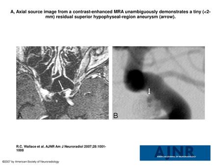 A, Axial source image from a contrast-enhanced MRA unambiguously demonstrates a tiny (