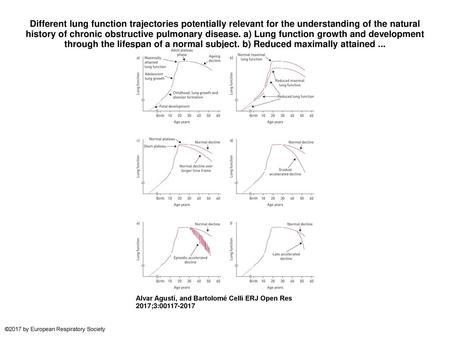 Different lung function trajectories potentially relevant for the understanding of the natural history of chronic obstructive pulmonary disease. a) Lung.