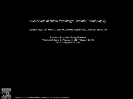 AJKD Atlas of Renal Pathology: Osmotic Tubular Injury