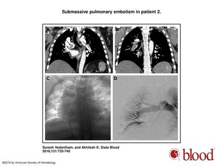 Submassive pulmonary embolism in patient 2.