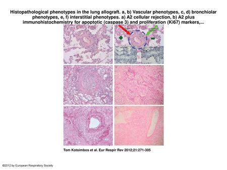 Histopathological phenotypes in the lung allograft