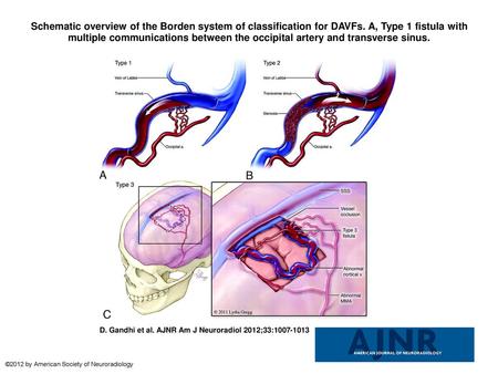 Schematic overview of the Borden system of classification for DAVFs