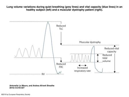 Lung volume variations during quiet breathing (grey lines) and vital capacity (blue lines) in an healthy subject (left) and a muscular dystrophy patient.