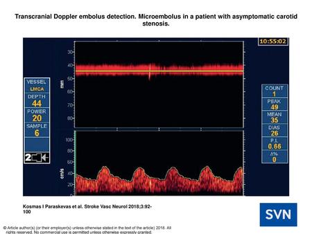 Transcranial Doppler embolus detection