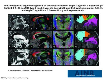 The 3 subtypes of segmental agenesis of the corpus callosum: SegACC type I in a 2-year-old girl (patient 3, A–D), segACC type II in a 5.4-year-old boy.