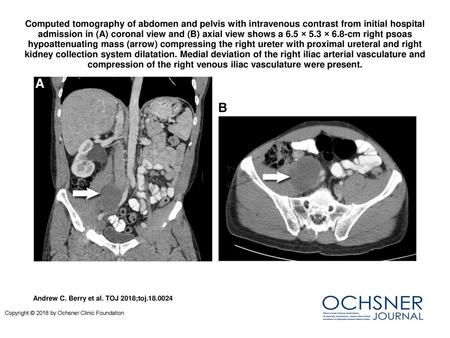 Computed tomography of abdomen and pelvis with intravenous contrast from initial hospital admission in (A) coronal view and (B) axial view shows a 6.5.