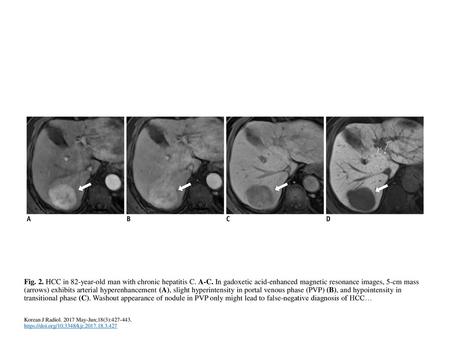 Fig. 2. HCC in 82-year-old man with chronic hepatitis C. A-C