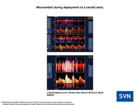 Microemboli during deployment of a carotid stent.