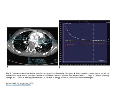 Fig. 5. Contrast-enhanced axial chest virtual monoenergetic dual-energy CT imaging. A. Three round regions of interest are placed in left atrium, back.